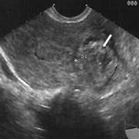 Laparoscopic View Of Interstitial Ectopic Pregnancy After Pitressin
