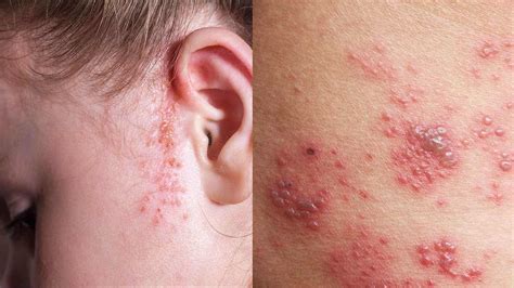 Understanding Skin Rashes Causes Symptoms And Treatment Options
