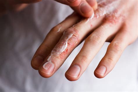 6 Homeopathic Remedies For Cracked Skin Homeopathy At