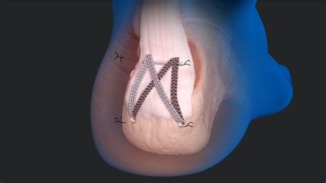 Arthrex Minimally Invasive Fibertak Achilles Speedbridge Repair