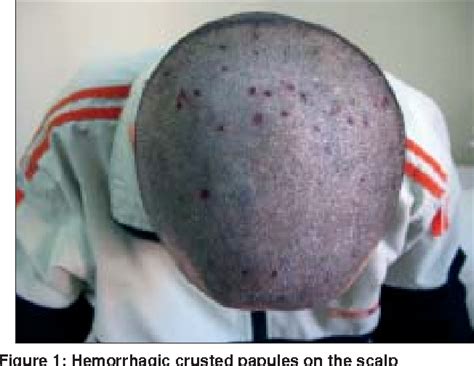 Figure From An Unusual Case Of Dermatitis Herpetiformis Presenting With Initial Scalp