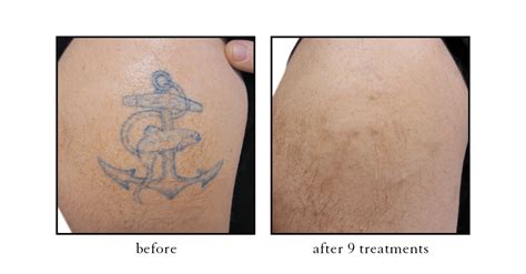 Traverse City Tattoo Removal Cosmetic Skin And Laser Center