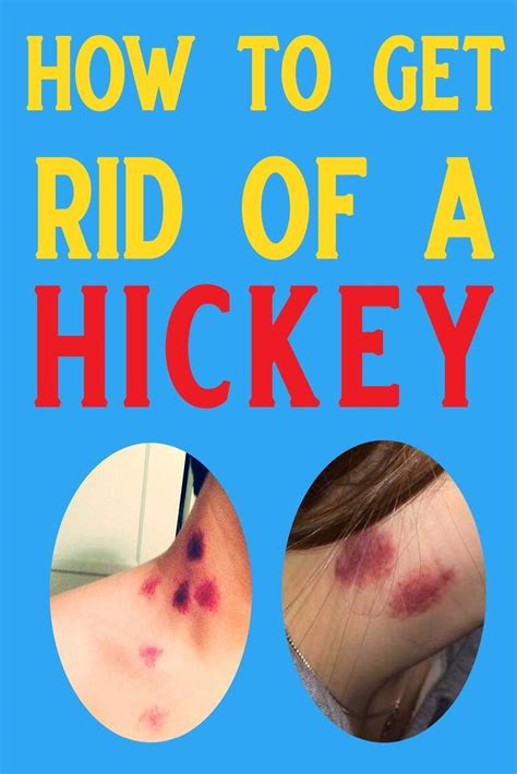 How To Get Rid Of A Hickey Faster Slide Share
