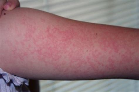 Sun Allergy Rash Pictures
