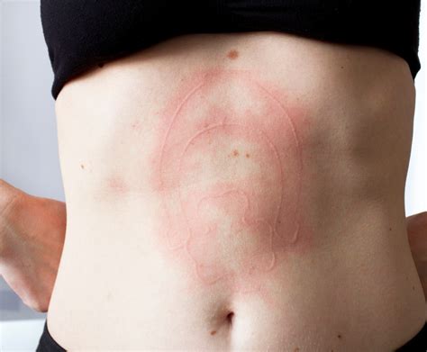 How Doing An Elimination Diet Can Help Heal Your Dermatographia Skintome