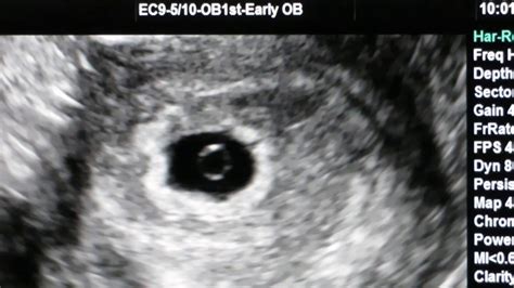1st Ultrasound At 5 Weeks And 4 Days Youtube