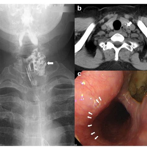 Preoperative Findings A Contrast Esophagography Showing A Diverticulum