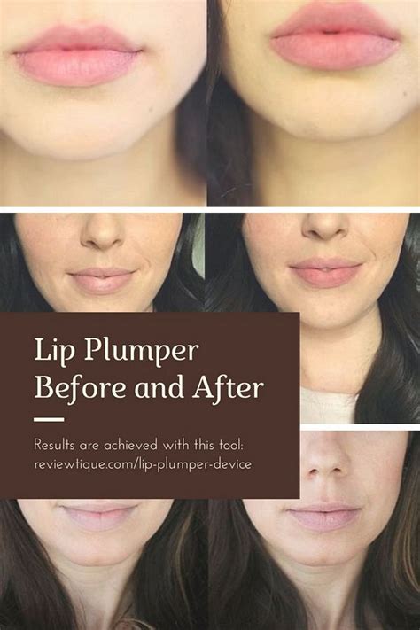 Lip Plumper Device Before And After Lips Become Bigger And More Full