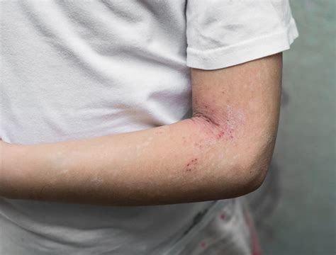Dermatita Atopica Ce Este Manifestari Cauze Tratament Secom
