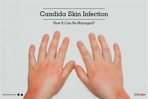 Candida Skin Infection How It Can Be Managed By Dr V Sethu Raman Lybrate
