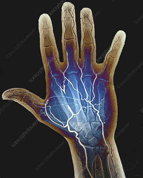 Blocked Hand Artery Angiogram Stock Image C0488752 Science
