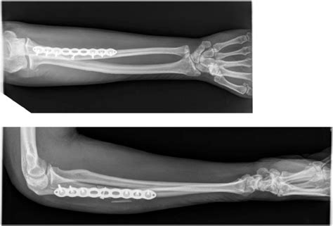 Adult Monteggia Fracture Dislocation Bado Type I Right Arm