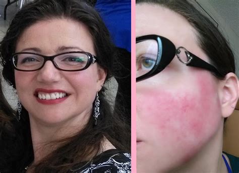How I Cover A Rosacea Flare Up With Makeup Talkhealth Blogtalkhealth Blog