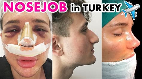 MY RHINOPLASTY NOSE JOB EXPERIENCE IN TURKEY Everything You Need