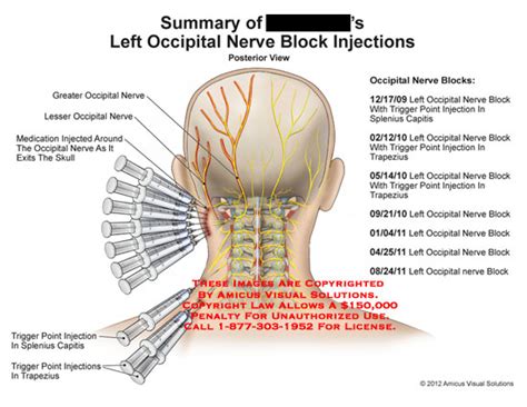 Summary Of Left Occipital Nerve Block Injections