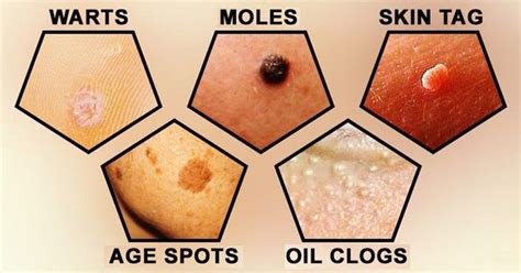 Acne Warts Clogged Pores Moles And Blackheads Are The Most Common