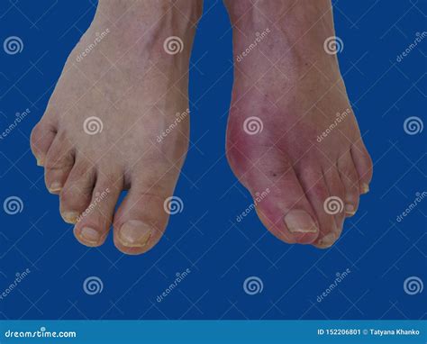 Foot Disease Rheumatism And Gout Red Leg Swelling Stock Image