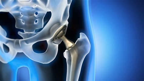 the partial hip replacement recovery timeline orange county orthopedic center