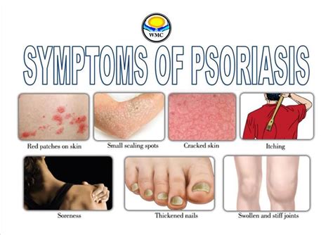 Here Are Some Of Common Symptoms Of Psoriasis We Provide Herbs