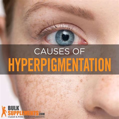 Hyperpigmentation Symptoms Causes And Treatment
