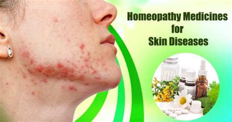 Homeopathic Treatment For Psoriasis Skin Disease Manday