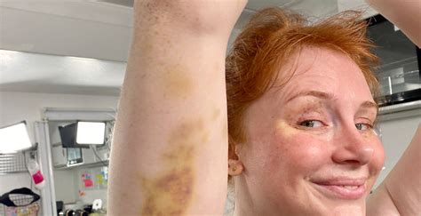 Bryce Dallas Howard Shows Off Her Massive Bruises From ‘jurassic World