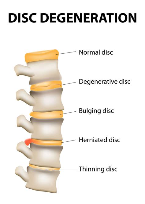 Herniated Or Bulging Discs Grant Chiropractic And Physical Therapy In