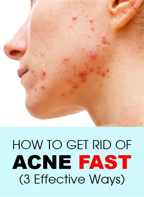 How To Get Rid Of Acne Fast 3 Effective Ways Fashion Daily