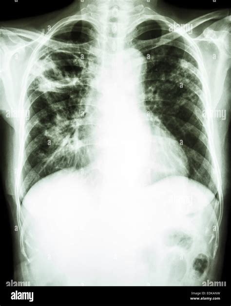Film radiographie de la montrer à la cavité pulmonaire supérieure