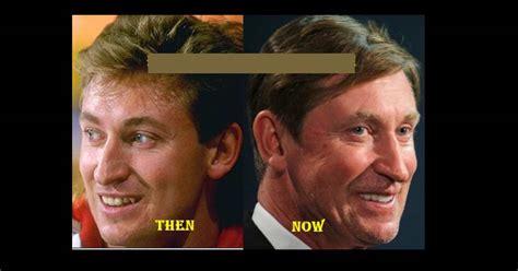 Wayne Gretzky Plastic Surgery Assessing The Possible Facelift And