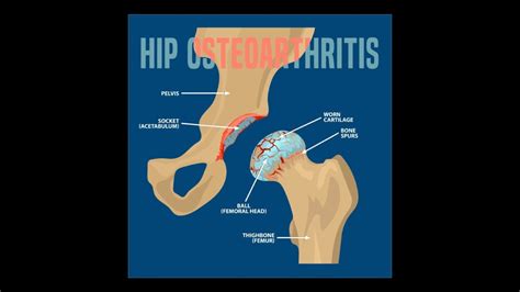 Hip Osteoarthritis And Hip Replacement Anniston Ortho