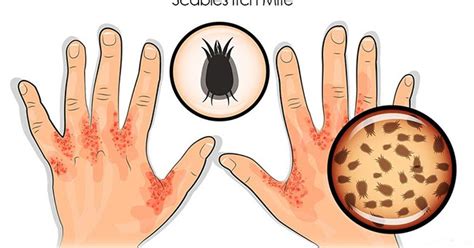 Ayurvedic Treatment For Scabies Skin Mites Symptoms Causes