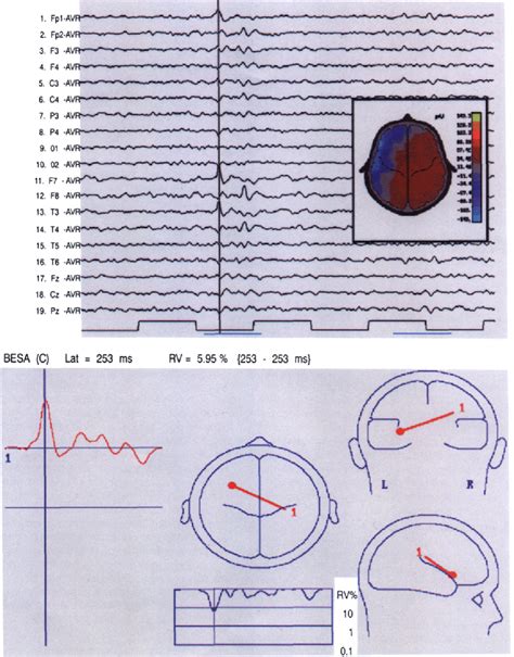 Figure 1 From Eeg Source Localization Of Interictal Epileptiform