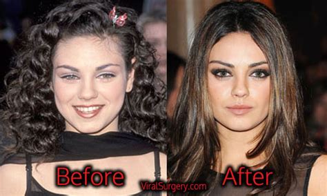 Mila Kunis Plastic Surgery Before And After Nose Boob Job Pictures