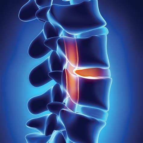 Herniated Disc Treatment Prism Pain Management
