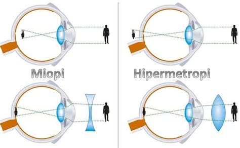 Perbedaan Miopia Dan Hipermetropi