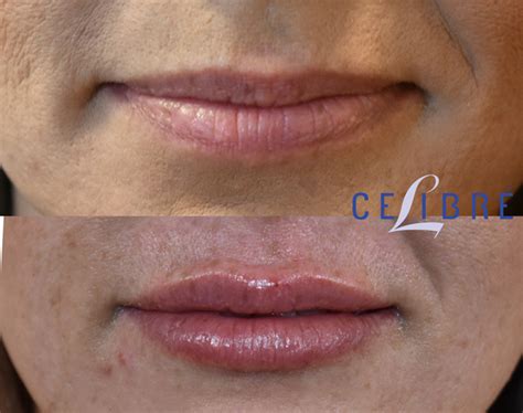 Before And After Photos Juvederm In Lipstick Alley