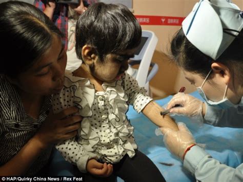 Chinese Girl Jing Jing With Rare Genetic Werewolf Syndrome To Receive Treatment Daily Mail