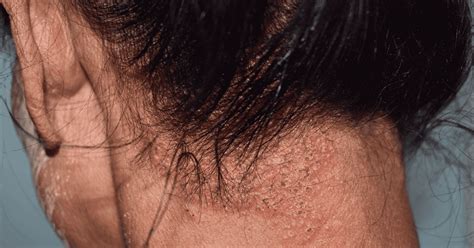 Seborrheic Dermatitis Types Causes Symptoms And Treatment