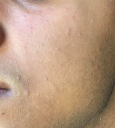I Have These Small Bumps Of My Cheeks But Im Not Sure What They Are