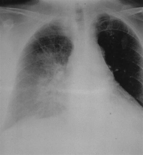 Clinical And Radiologic Features Of Pulmonary Edema Radiographics