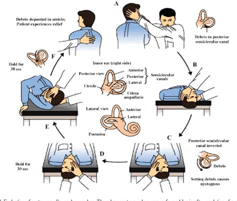 Figure From Advances In The Diagnosis And Treatment Of Benign Paroxysmal Positional Vertigo