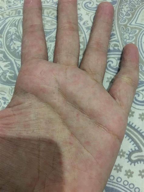 Ask A Dermatologist Online For Red Spots On Hand