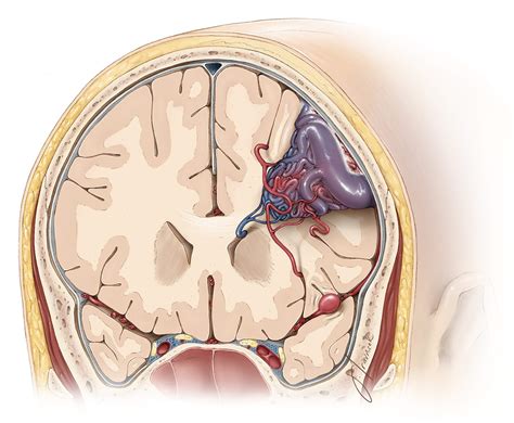 Nuances In Avm Resection The Neurosurgical Atlas By Aaron Cohen Gadol M D
