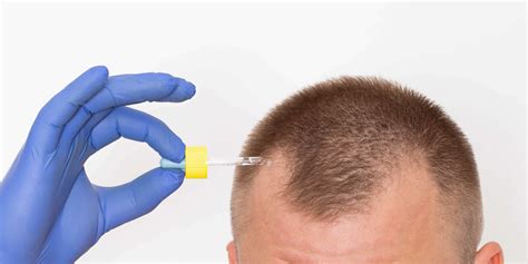Thinning Hair Causes And Treatment By Vampire Hair Restoration