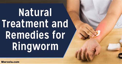 Natural Treatment And Remedies For Ringworm