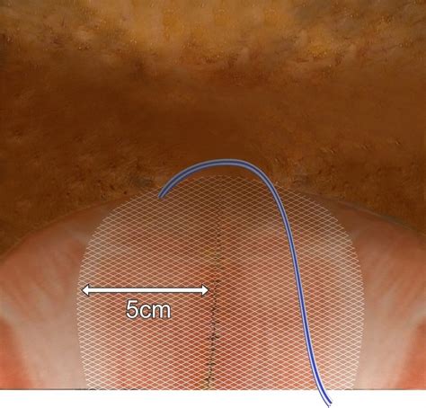 Mesh Placement After Dr Plication And Hernia Repair With 5 Cm Overlap