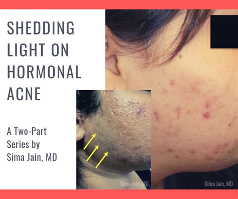 Part 1 Hormonal Acne Exam Work Up And Diagnosis Next Steps In