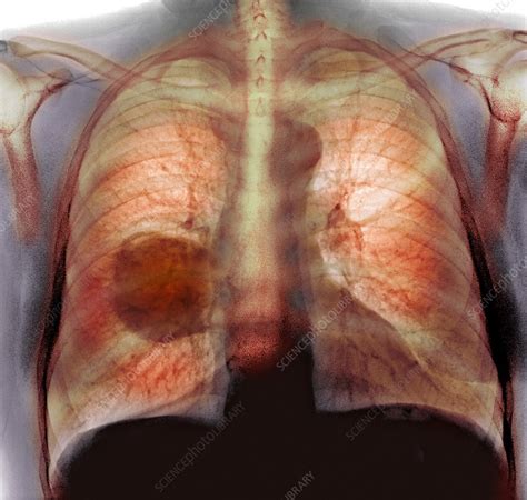 Lung Cancer X Ray Stock Image C0164433 Science Photo Library