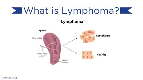 Pathophysiology Of Lymphoma